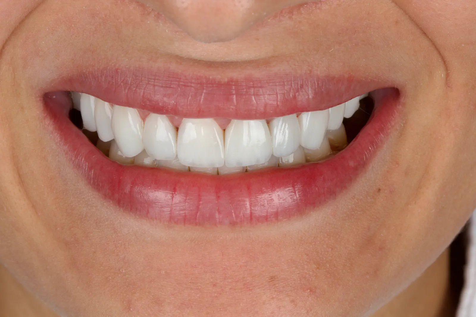 Sorriso feminino após facetas, com formato delicado e cor próxima da original